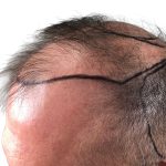 Hair Transplants Before & After Patient #3653