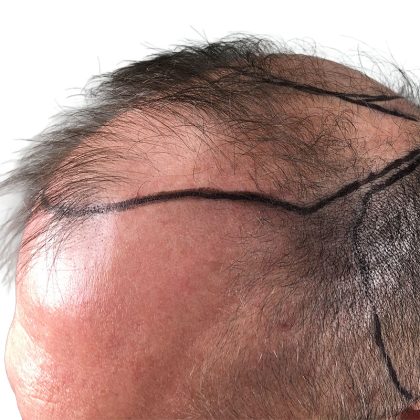 Hair Transplants Before & After Patient #3653