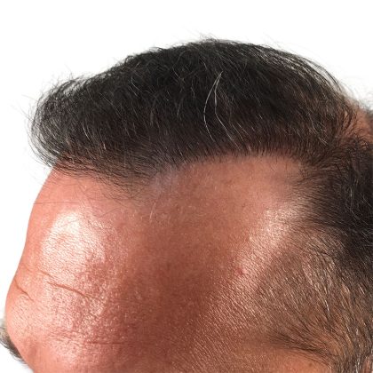 Hair Transplants Before & After Patient #3653