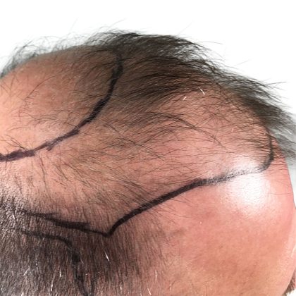 Hair Transplants Before & After Patient #3653