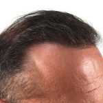 Hair Transplants Before & After Patient #3653