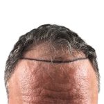 Hair Transplants Before & After Patient #3685