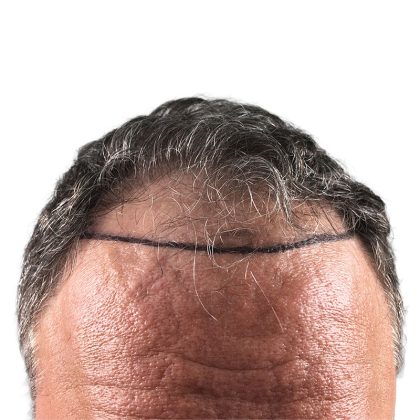 Hair Transplants Before & After Patient #3685
