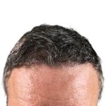 Hair Transplants Before & After Patient #3685