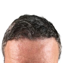 Hair Transplants Before & After Patient #3685