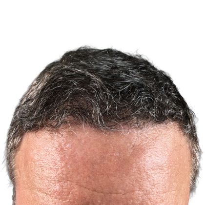 Hair Transplants Before & After Patient #3685