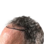 Hair Transplants Before & After Patient #3685