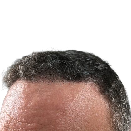 Hair Transplants Before & After Patient #3685