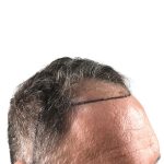 Hair Transplants Before & After Patient #3685