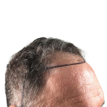 Hair Transplants Before & After Patient #3685