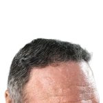 Hair Transplants Before & After Patient #3685