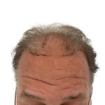 Hair Transplants Before & After Patient #3686
