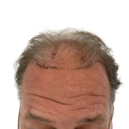Hair Transplants Before & After Patient #3686