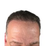 Hair Transplants Before & After Patient #3686