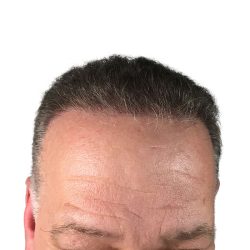 Hair Transplants Before & After Patient #3686