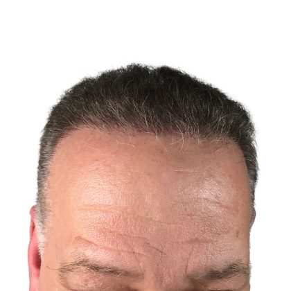 Hair Transplants Before & After Patient #3686