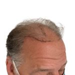 Hair Transplants Before & After Patient #3686