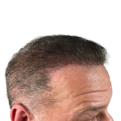 Hair Transplants Before & After Patient #3686