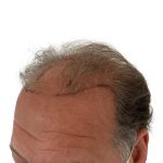 Hair Transplants Before & After Patient #3686