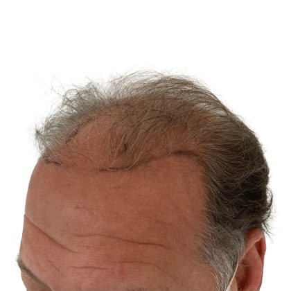 Hair Transplants Before & After Patient #3686