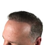 Hair Transplants Before & After Patient #3686