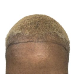 Hair Transplants Before & After Patient #3687