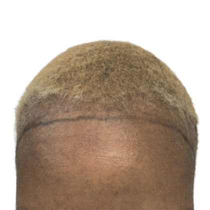 Hair Transplants Before & After Patient #3687