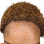 Hair Transplants Before & After Patient #3687