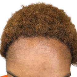 Hair Transplants Before & After Patient #3687