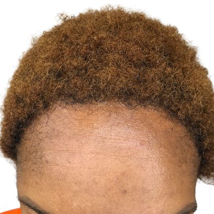 Hair Transplants Before & After Patient #3687