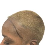 Hair Transplants Before & After Patient #3687