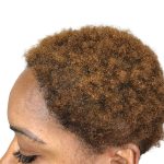 Hair Transplants Before & After Patient #3687