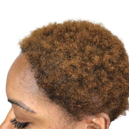 Hair Transplants Before & After Patient #3687