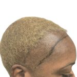 Hair Transplants Before & After Patient #3687
