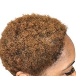 Hair Transplants Before & After Patient #3687