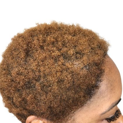 Hair Transplants Before & After Patient #3687