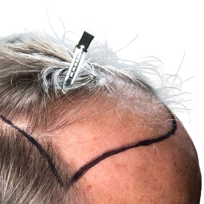 Hair Transplants Before & After Patient #3688