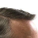Hair Transplants Before & After Patient #3688