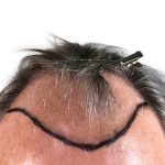 Hair Transplants Before & After Patient #3688