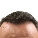 Hair Transplants Before & After Patient #3688