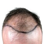 Hair Transplants Before & After Patient #3689