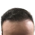 Hair Transplants Before & After Patient #3689