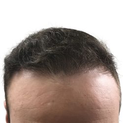 Hair Transplants Before & After Patient #3689