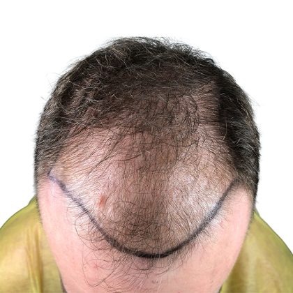 Hair Transplants Before & After Patient #3689
