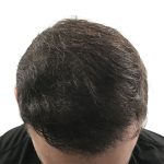 Hair Transplants Before & After Patient #3689