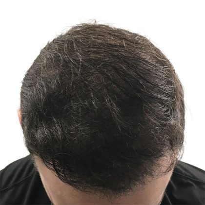 Hair Transplants Before & After Patient #3689