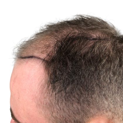 Hair Transplants Before & After Patient #3689