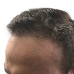 Hair Transplants Before & After Patient #3689