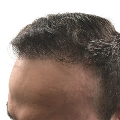Hair Transplants Before & After Patient #3689