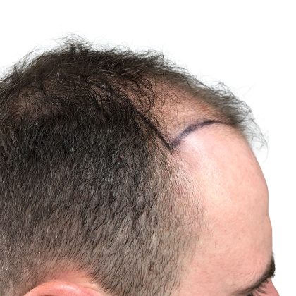 Hair Transplants Before & After Patient #3689